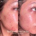 Blue + Red Light Acne Wand — compact handheld device with dual light modes